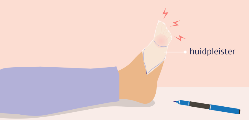 De pijnarts in het ziekenhuis kan de Qutenza® pleister plakken als je pijn hebt op 1 plek door beschadigde zenuwen in je huid, bijvoorbeeld op de voet..