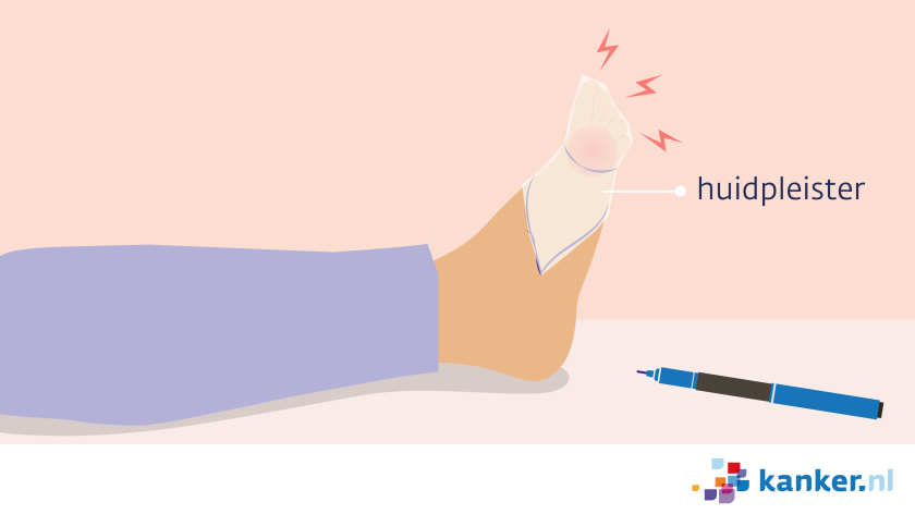 De pijnarts in het ziekenhuis kan de Qutenza® pleister plakken als je pijn hebt op 1 plek door beschadigde zenuwen in je huid, bijvoorbeeld op de voet.