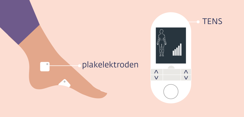 Bij een TENS-behandeling krijg je elektrische stroompjes via 1 of 2 elektrodes op je huid en een apparaatje dat je bij je draagt.