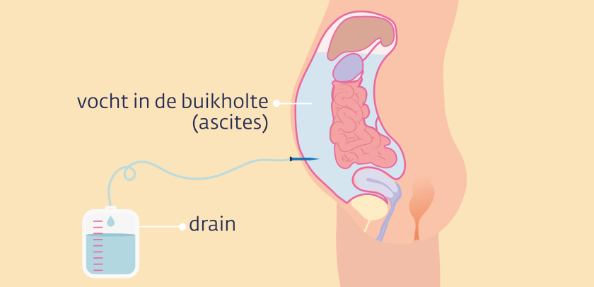 Een ascitesdrain zit via een sneetje in de buikholte. Aan het slangetje (de drain) hangt een zak. Het vocht loopt door het slangetje in de zak.
