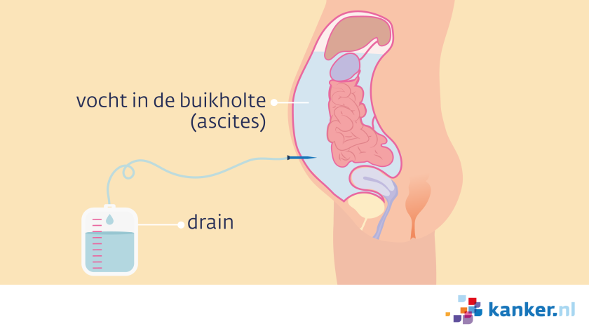 Een ascitesdrain zit via een sneetje in de buikholte. Aan het slangetje (de drain) hangt een zak. Het vocht loopt door het slangetje in de zak.