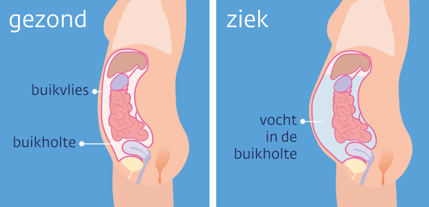 Vocht in de buikholte (ascites) gaat om alle organen heen zitten.