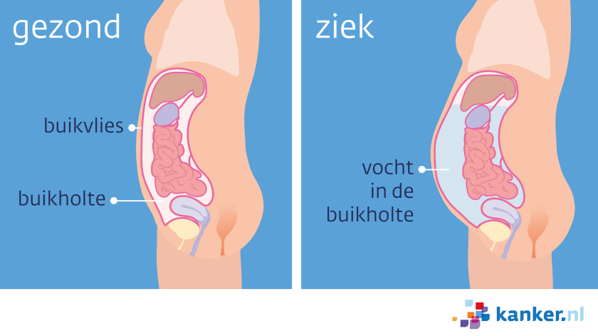 Vocht in de buikholte (ascites) gaat om alle organen heen zitten.