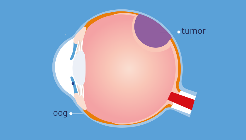 De tumor bij oogmelanoom kan in het vaatvlies zitten