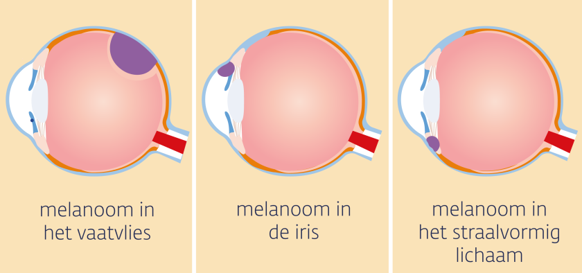 Een oogmelanoom begint in het vaatvlies, in de iris of in het straalvormig lichaam.