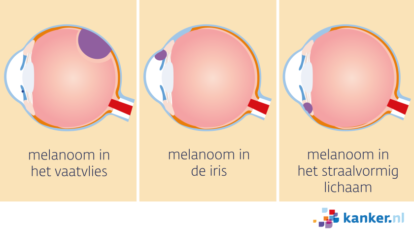 Een oogmelanoom begint in het vaatvlies, in de iris of in het straalvormig lichaam.