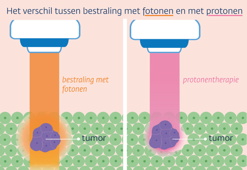 Bij een bestraling met protonen wordt minder omliggend weefsel bestraald dan met een bestraling met fotonen.