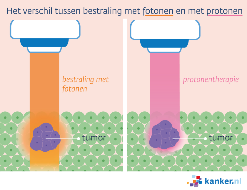 Bij een bestraling met protonen wordt minder omliggend weefsel bestraald dan met een bestraling met fotonen.