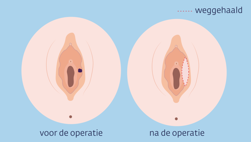 Bij een operatie bij schaamlipkanker wordt het deel van de schaamlip waar de tumor zit, weggesneden.