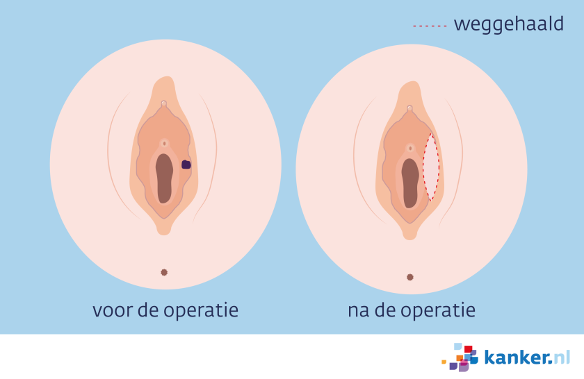 Bij een operatie bij schaamlipkanker wordt het deel van de schaamlip waar de tumor zit, weggesneden.