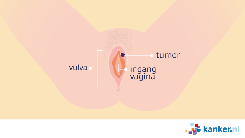 De tumor bevindt zich op een van de schaamlippen