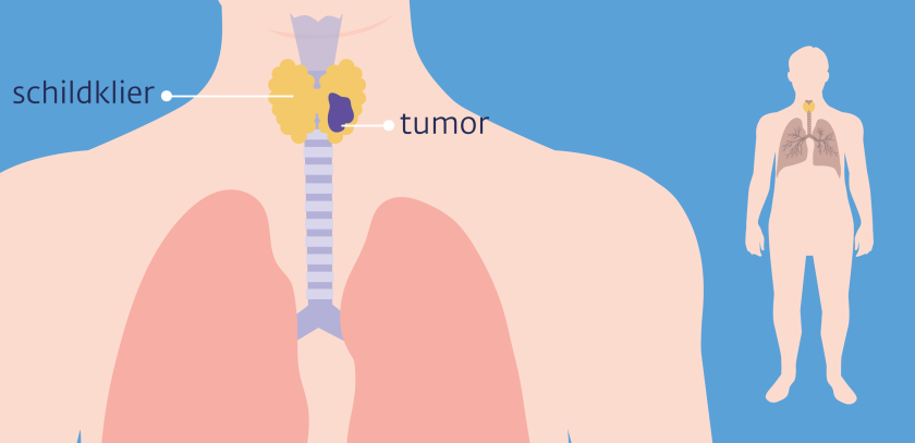 de tumor zit bij schildklierkanker op de schildklier