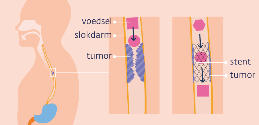 Een stent houdt de slokdarm open op de plek van de tumor zodat er drinken en fijn voedsel doorheen kan.
