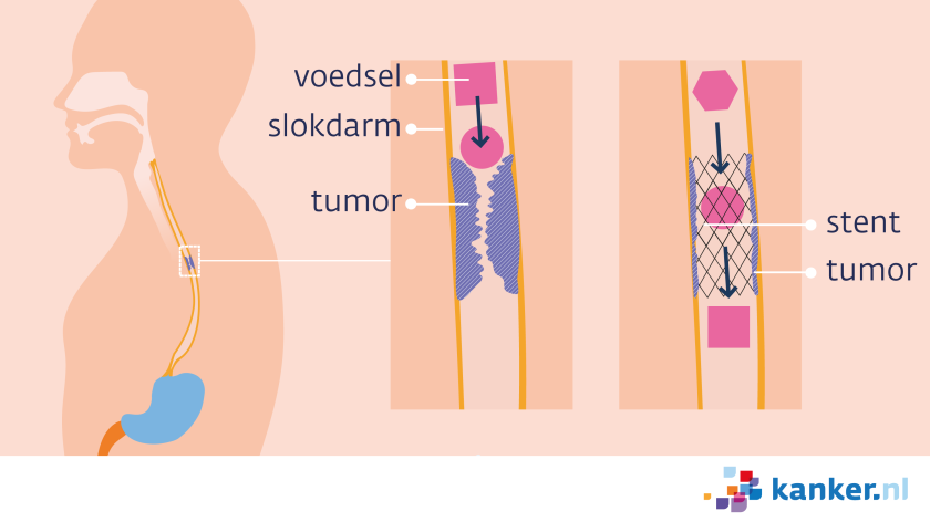 Een stent houdt de slokdarm open op de plek van de tumor zodat er drinken en fijn voedsel doorheen kan.