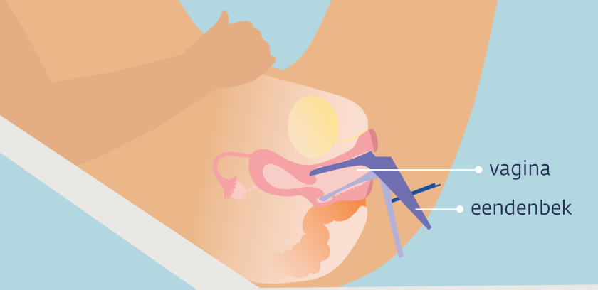 Bij een speculumonderzoek brengt de arts een eendenbek (speculum) in de vagina.