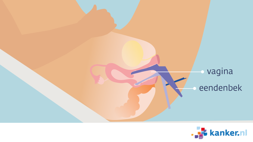 Bij een speculumonderzoek brengt de arts een eendenbek (speculum) in de vagina.