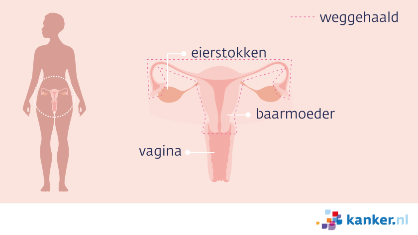 Bij een baarmoederverwijdering bij trofoblastziekten haalt de arts ook de eierstokken weg