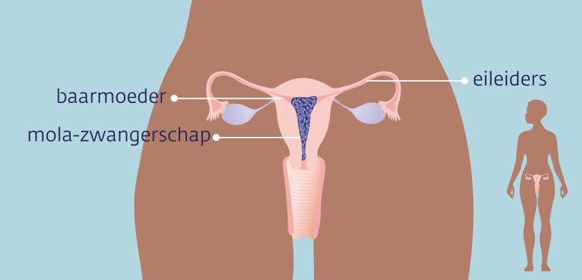 Bij een mola-zwangerschap groeit er geen embryo in de baarmoeder, maar een soort gezwel van kleine blaasjes