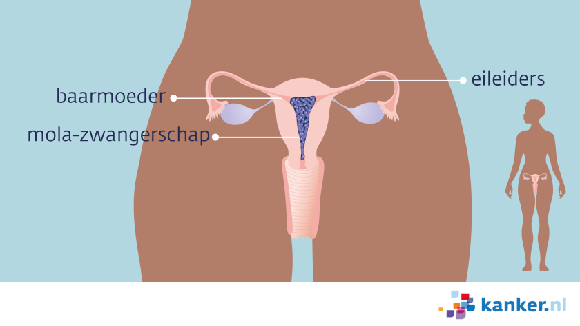 mola-zwangeschap