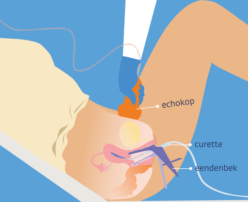 Bij een vacuümcurettage haalt de arts met behulp van een eendenbek en een curette de mola-blaasjes weg.