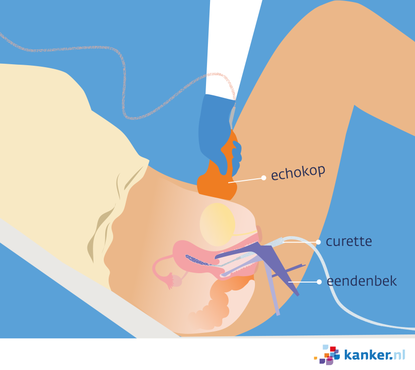 Bij een vacuümcurettage haalt de arts met behulp van een eendenbek en een curette de mola-blaasjes weg.
