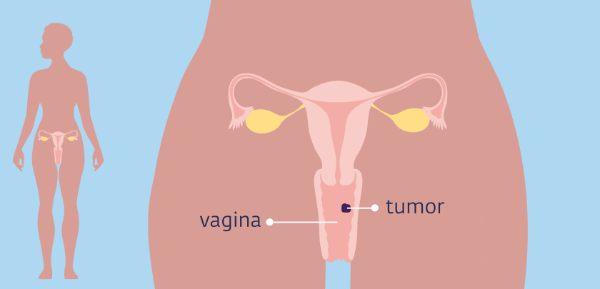De vagina met tumor erin getekend