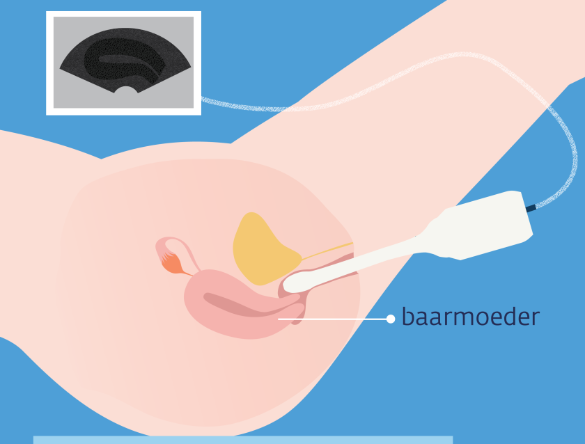 Bij een vaginale echo lig je op je rug en wordt het echo-apparaat in de vagina gebracht.