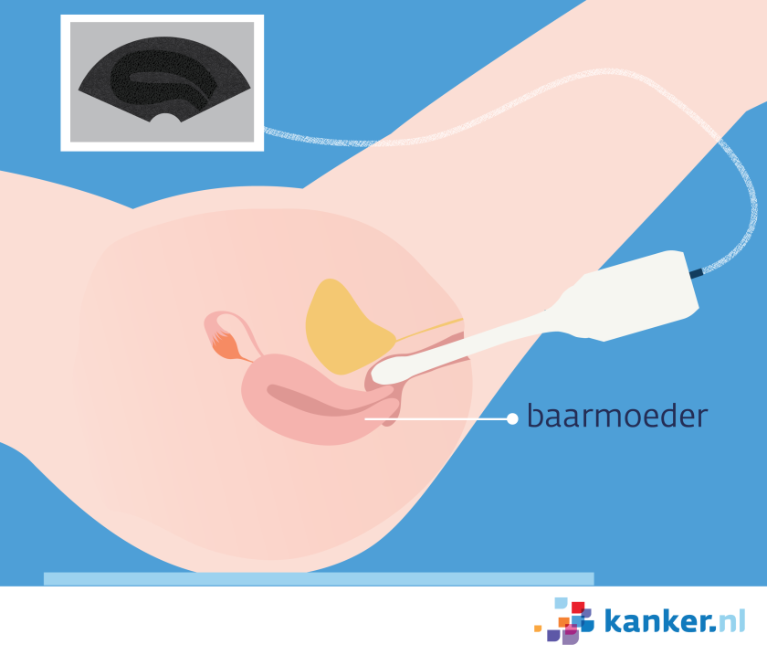 Bij een vaginale echo lig je op je rug en wordt het echo-apparaat in de vagina gebracht.