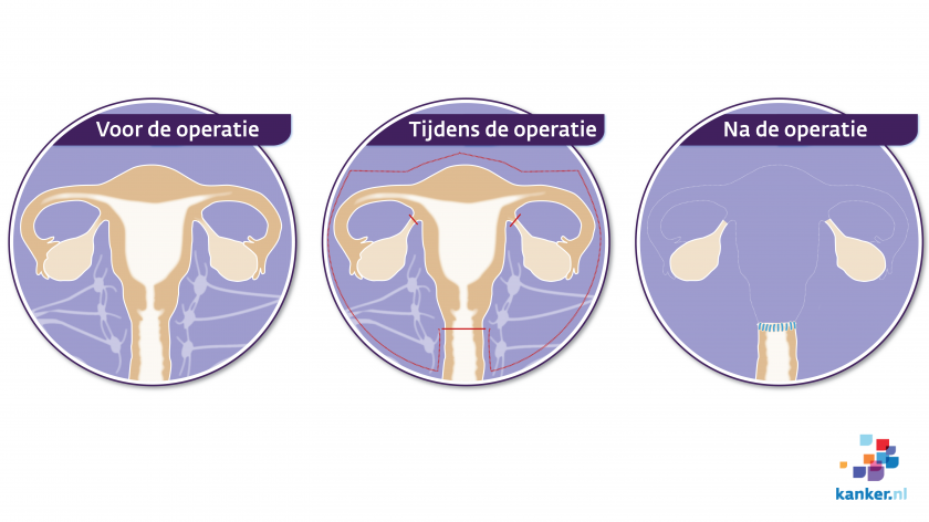 Bij een Wertheim-operatie verwijdert de arts de baarmoeder en de baarmoederhals, samen met omliggende weefsels