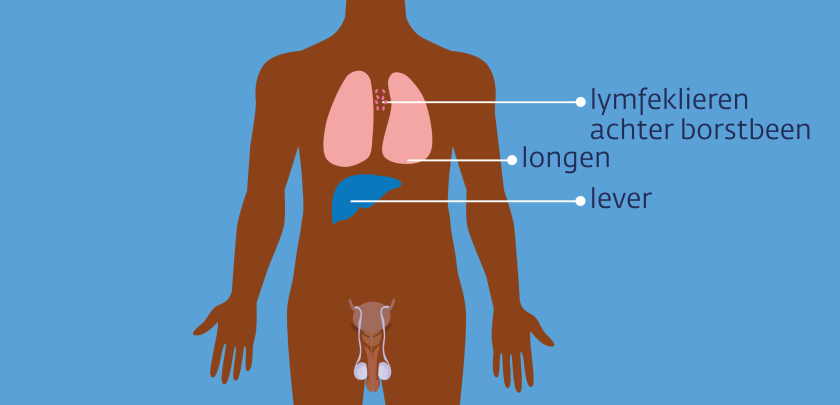 uitzaaiingen van zaadbalkanker kunnen zitten in de lymfeklieren achter het borstbeen, de longen en de lever