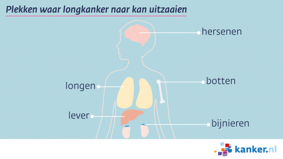 Uitzaaiingen bij longkanker | kanker.nl