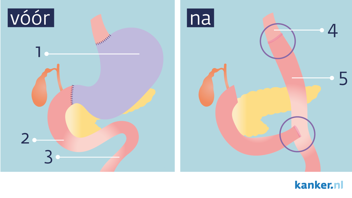 Operatie bij maagkanker / adenocarcinoom / maagcarcinoom Operatie bij maagkanker / adenocarcinoom / maagcarcinoom