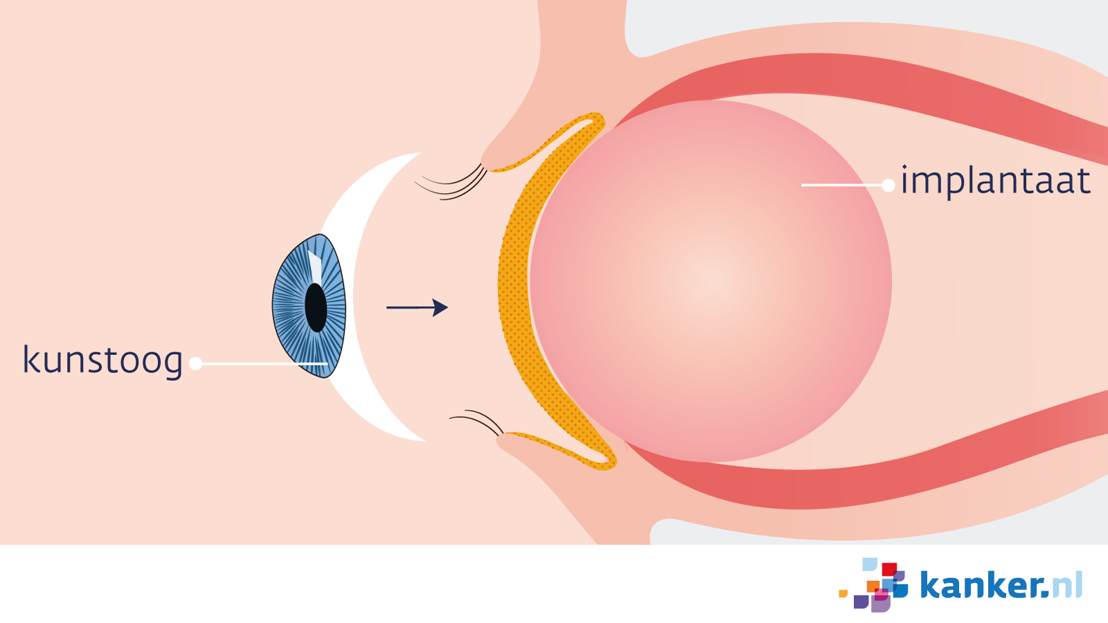 schakelaar wetenschapper Hymne Verwijdering van het oog (enucleatie) bij oogmelanoom