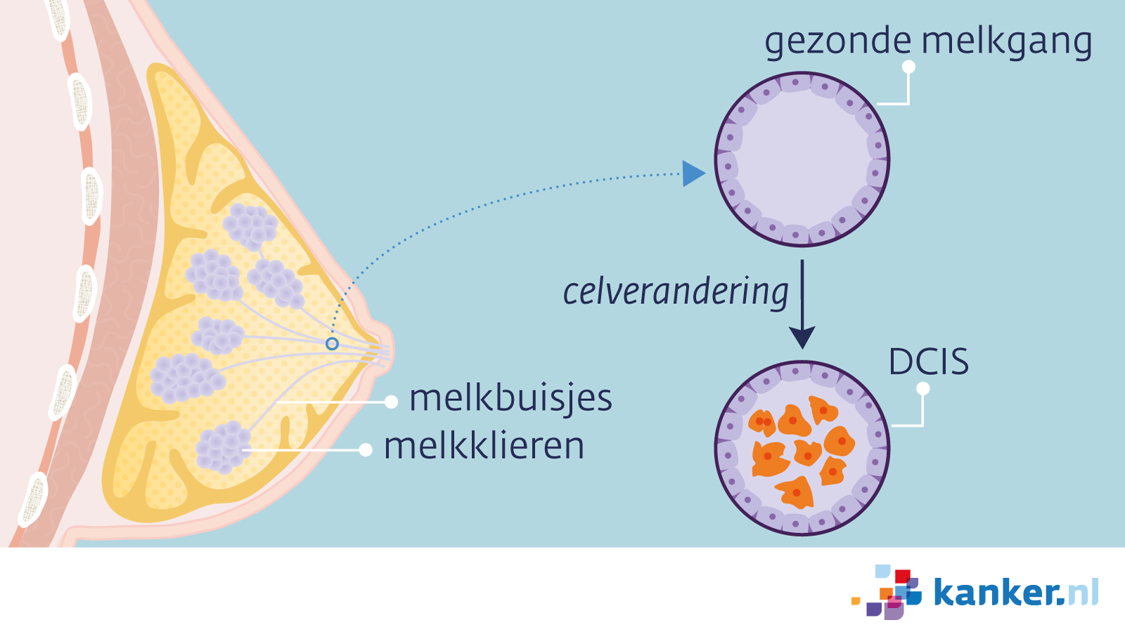 invasief carcinoom nst graad 1