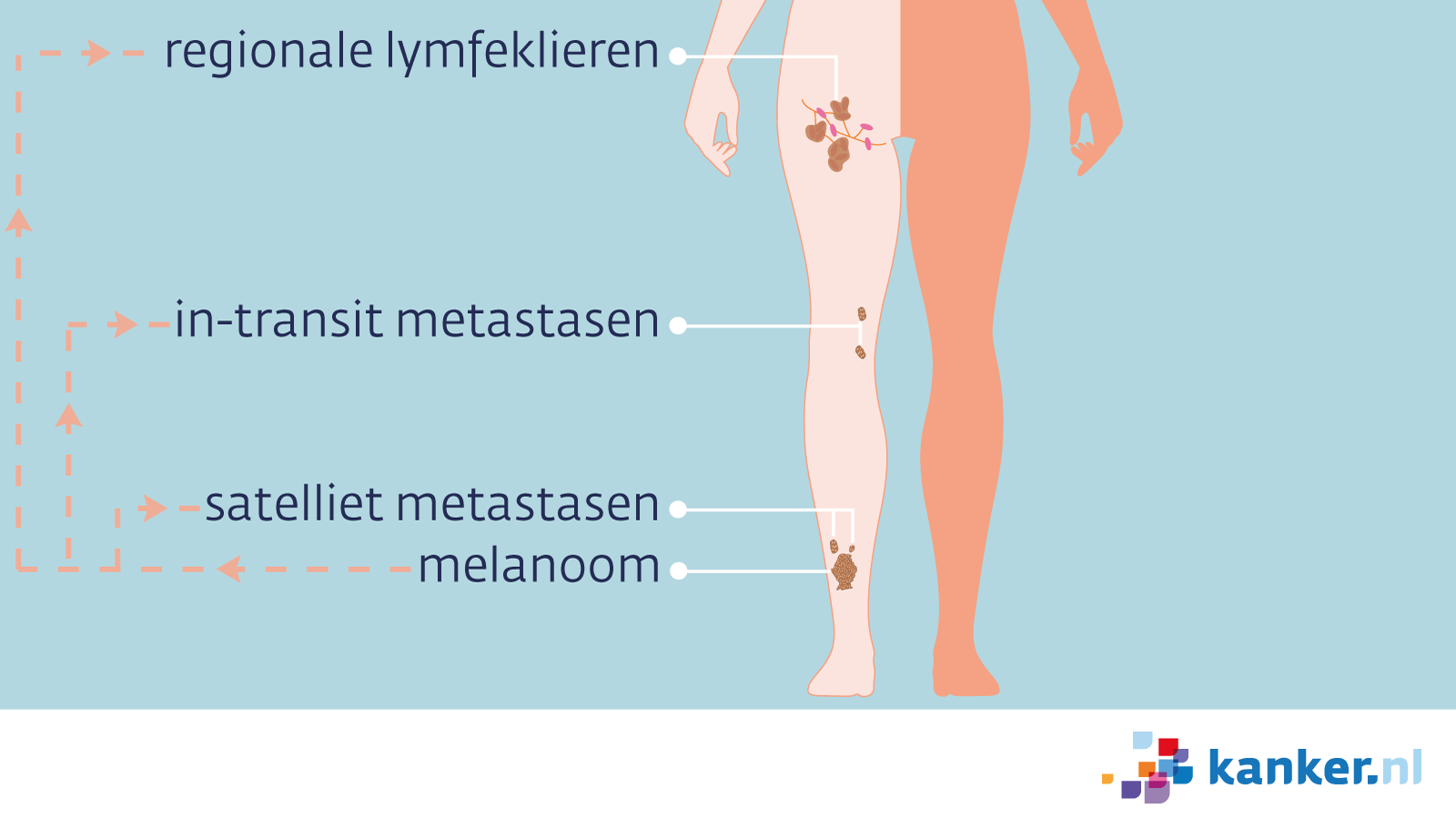 Uitzaaiingen van melanoom | Kanker.nl Uitzaaiingen Van Melanoom | Kanker.Nl