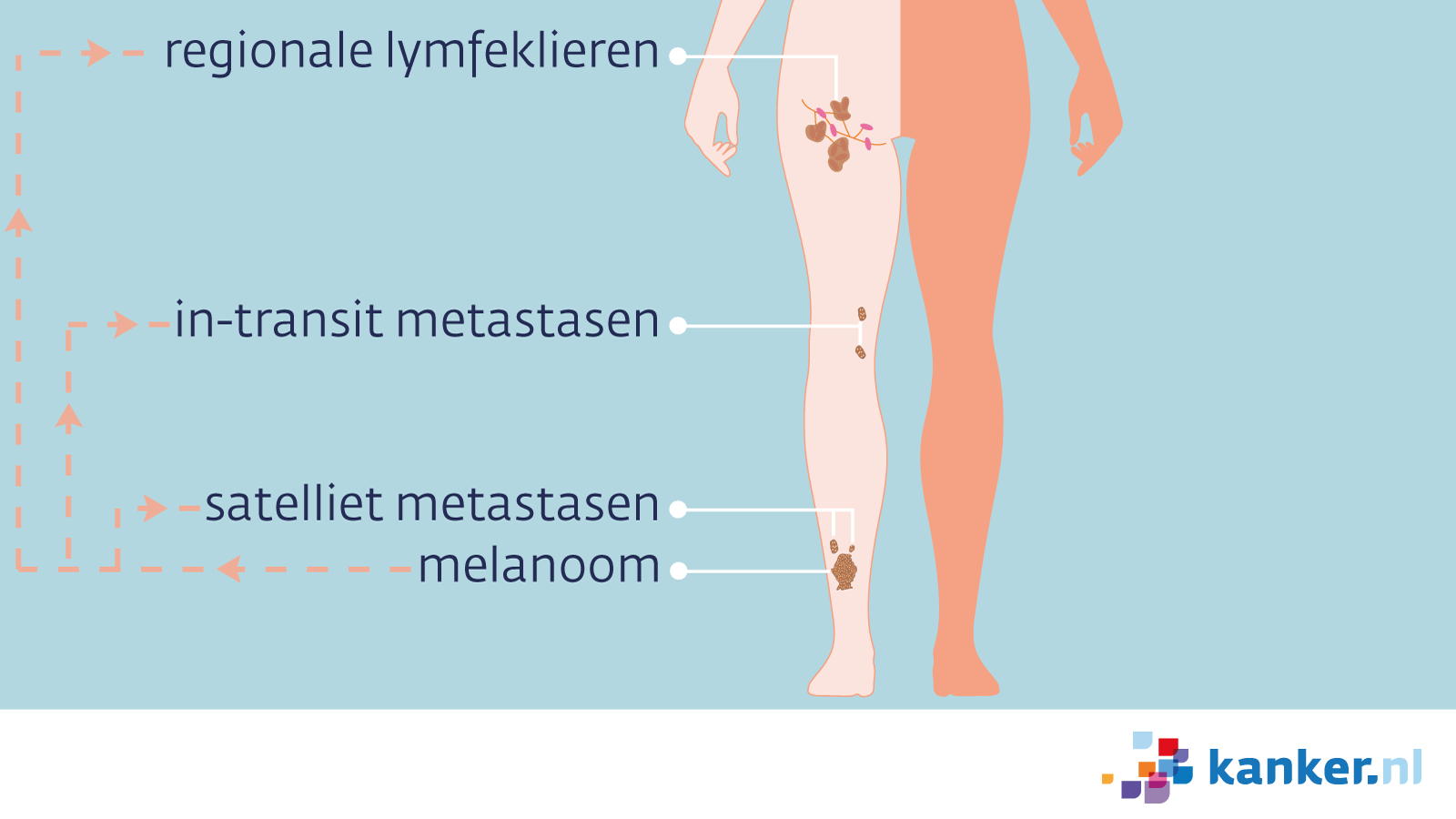 Uitzaaiingen Van Melanoom | Kanker.Nl