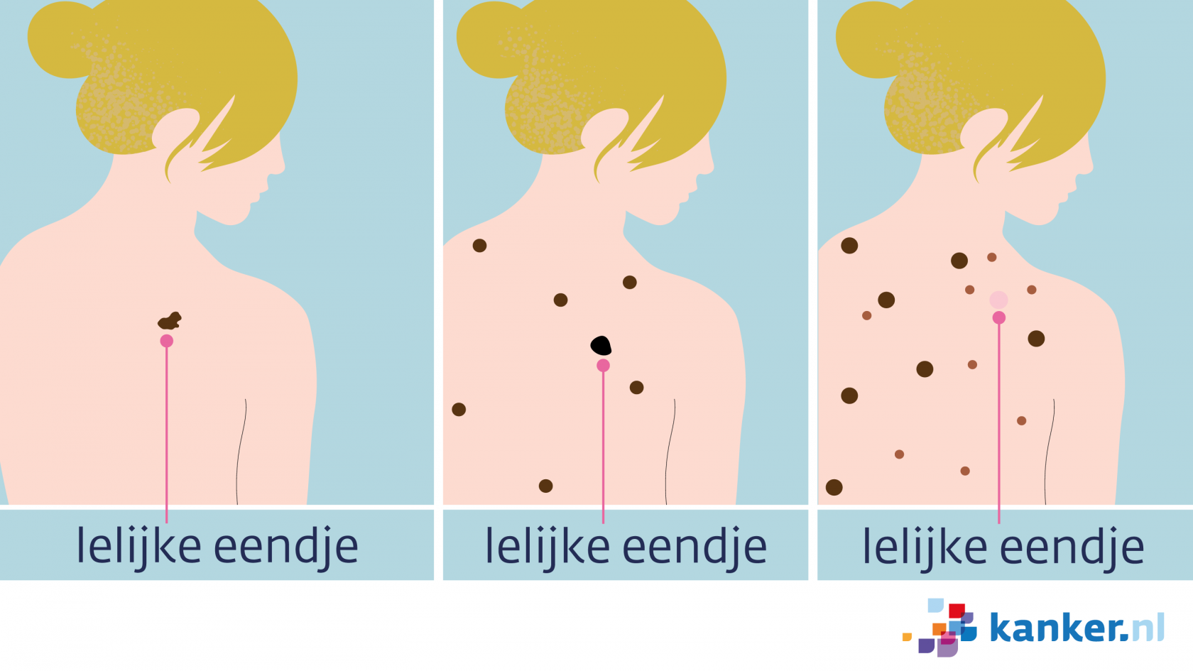 Hoe Herken Je Een Melanoom