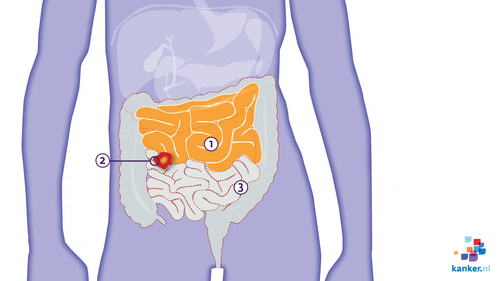 Preventieve operatie bij adenomateuze polyposis Preventieve operatie bij adenomateuze polyposis