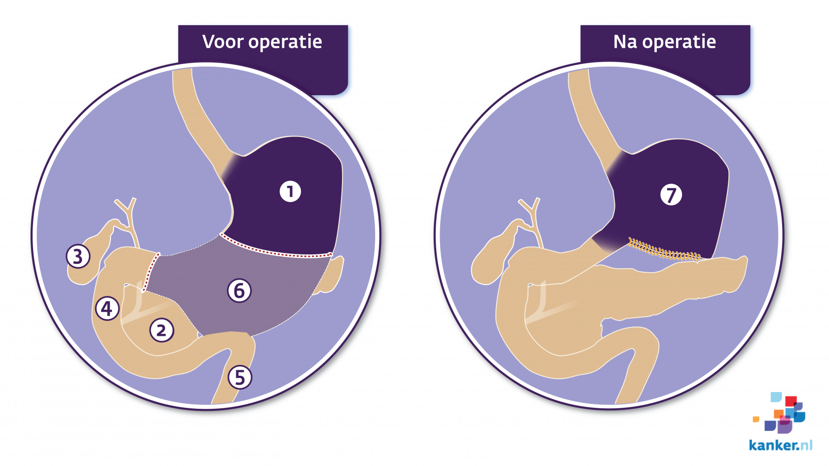 Operatie bij maagkanker / adenocarcinoom / maagcarcinoom