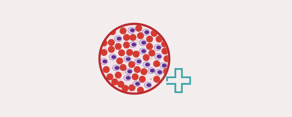 Acute myeloïde leukemie keuzehulp