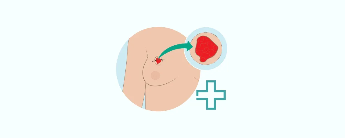 Patientplus borstkankeroperatie