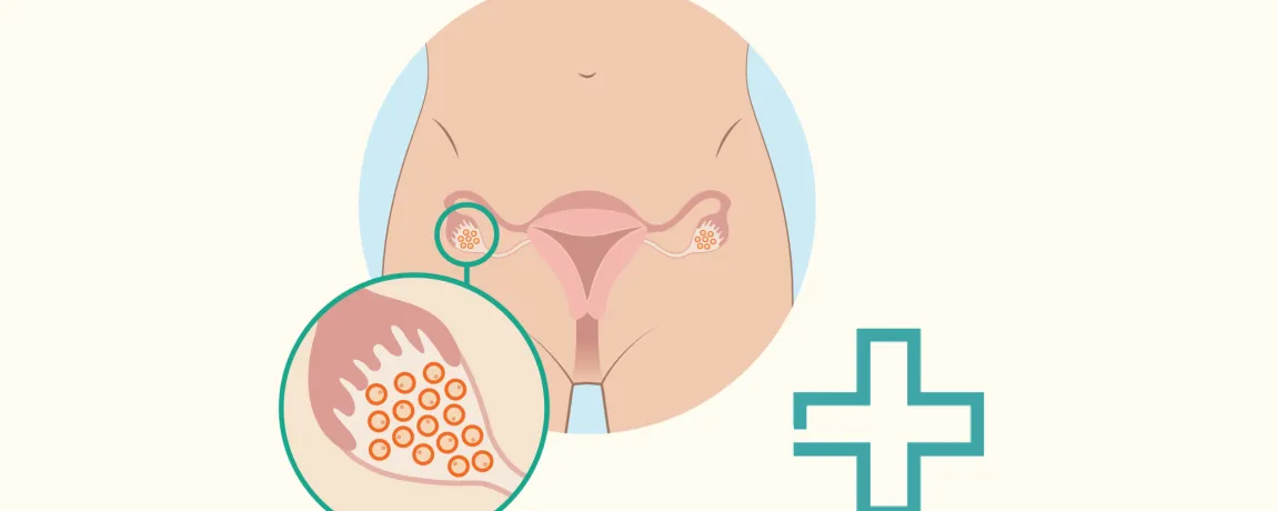 Multiple myeloom en kinderwens: keuzehulp