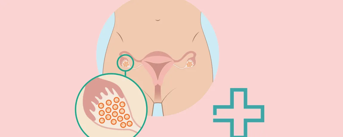 Acute leukemie en kinderwens: keuzehulp